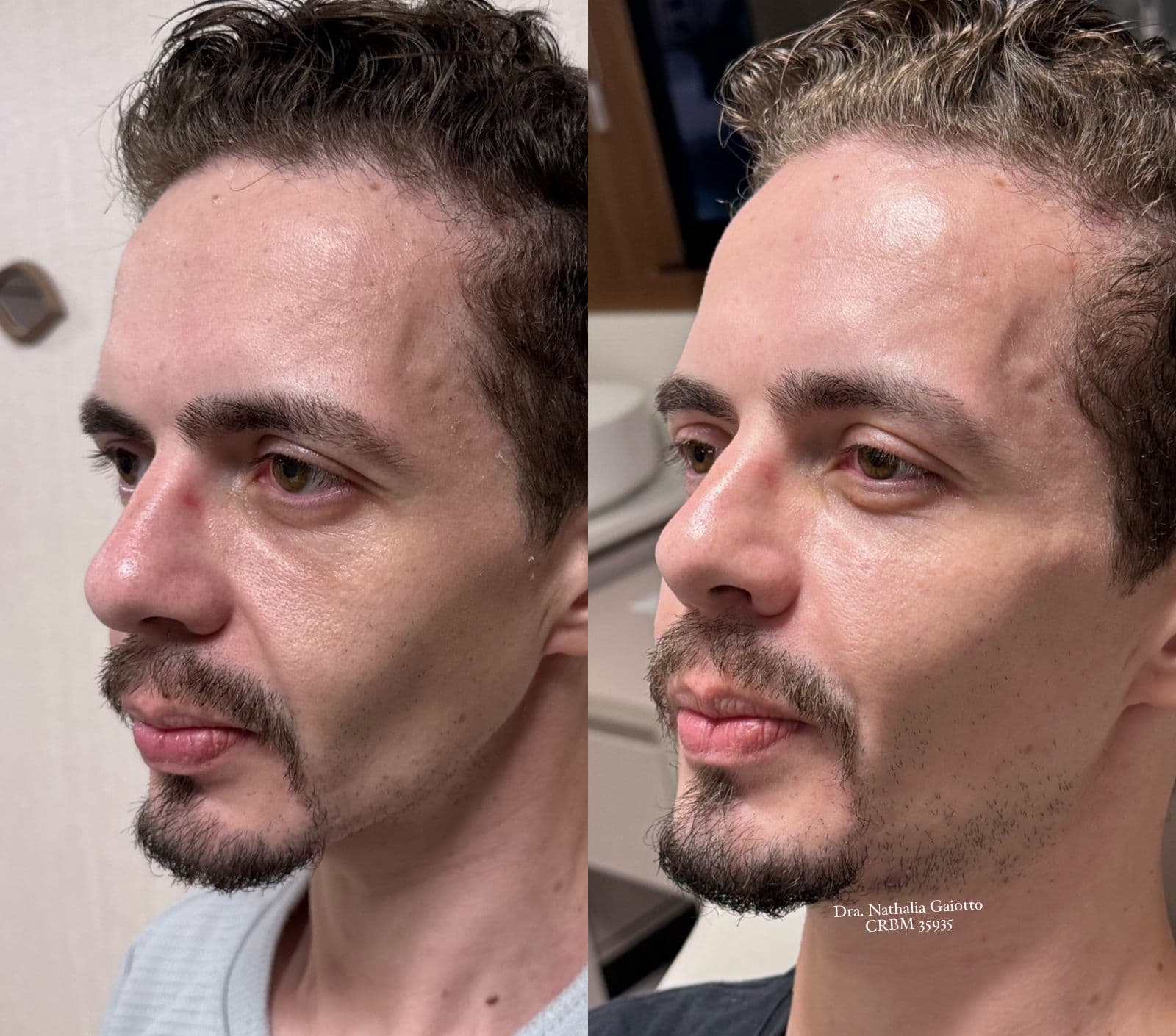 Antes e depois — Harmonização Facial, NG Clinic