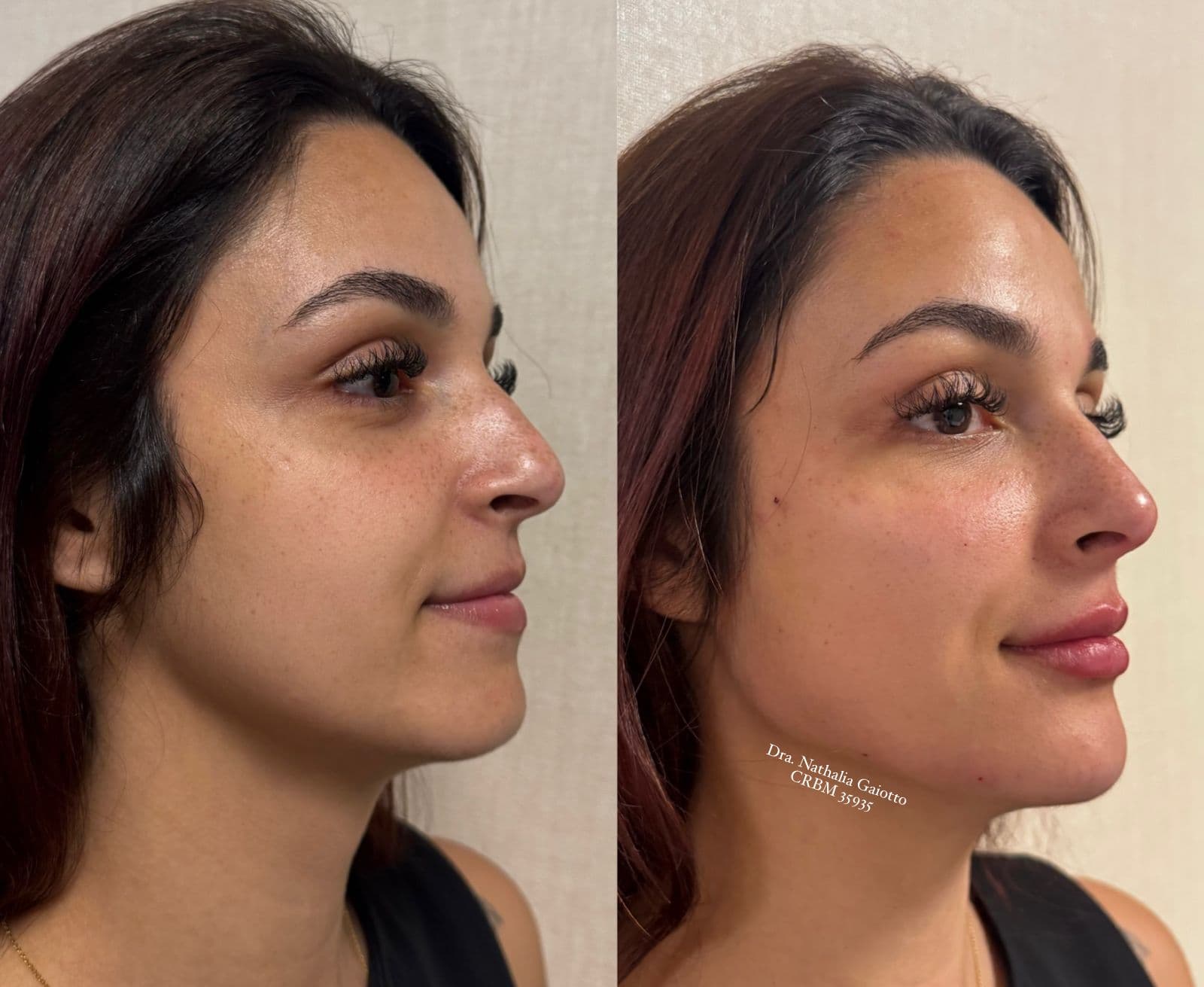 Antes e depois — Harmonização Facial, NG Clinic