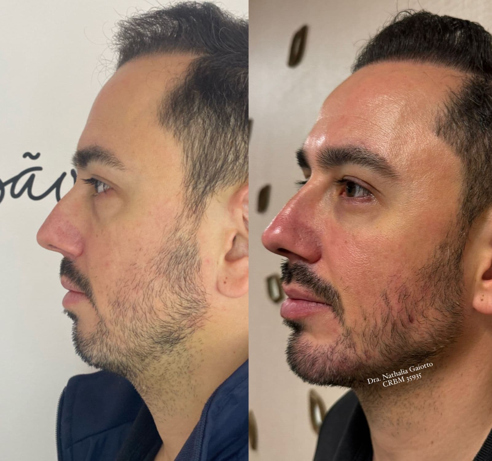 Antes e depois — Harmonização Facial, NG Clinic