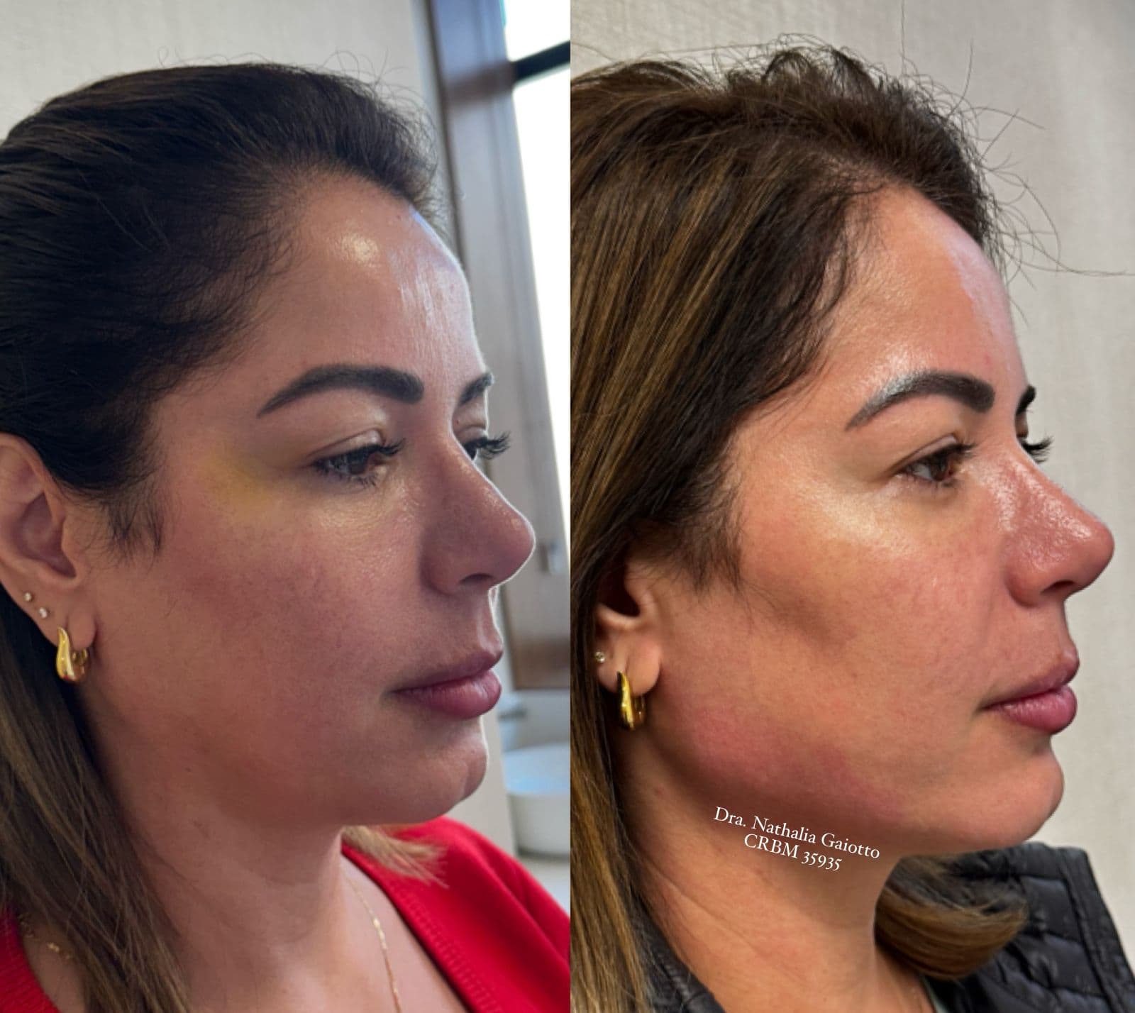 Antes e depois — Harmonização Facial, NG Clinic
