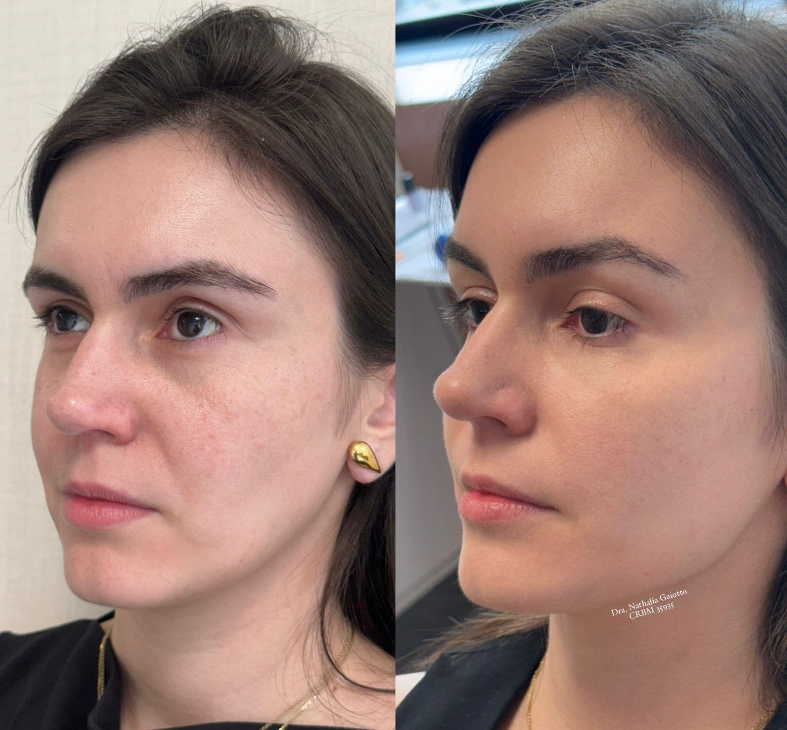 Antes e depois — Harmonização Facial, NG Clinic