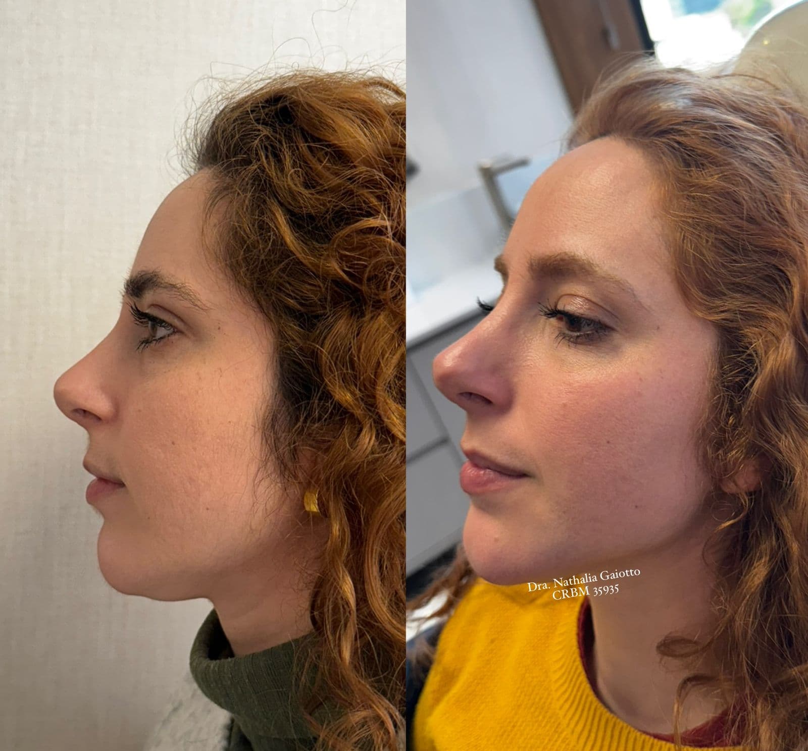 Antes e depois — Harmonização Facial, NG Clinic