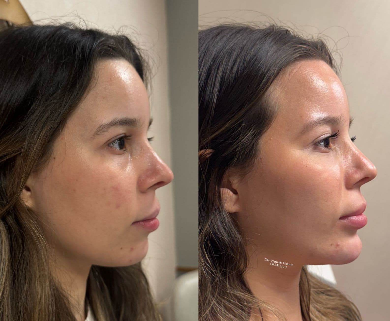 Antes e depois — Harmonização Facial, NG Clinic
