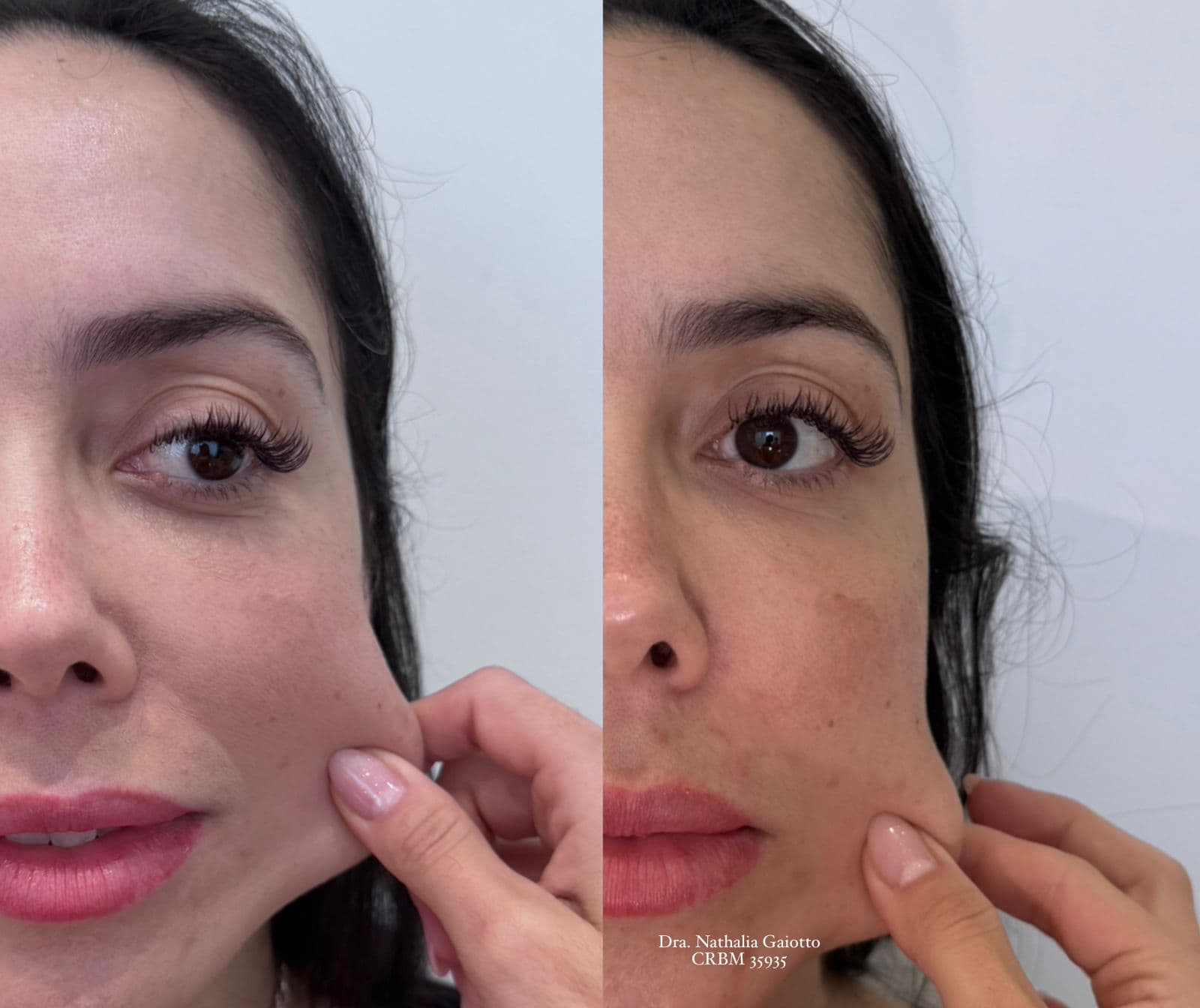 Antes e depois — Ultrassom Microfocado (HIFU), NG Clinic