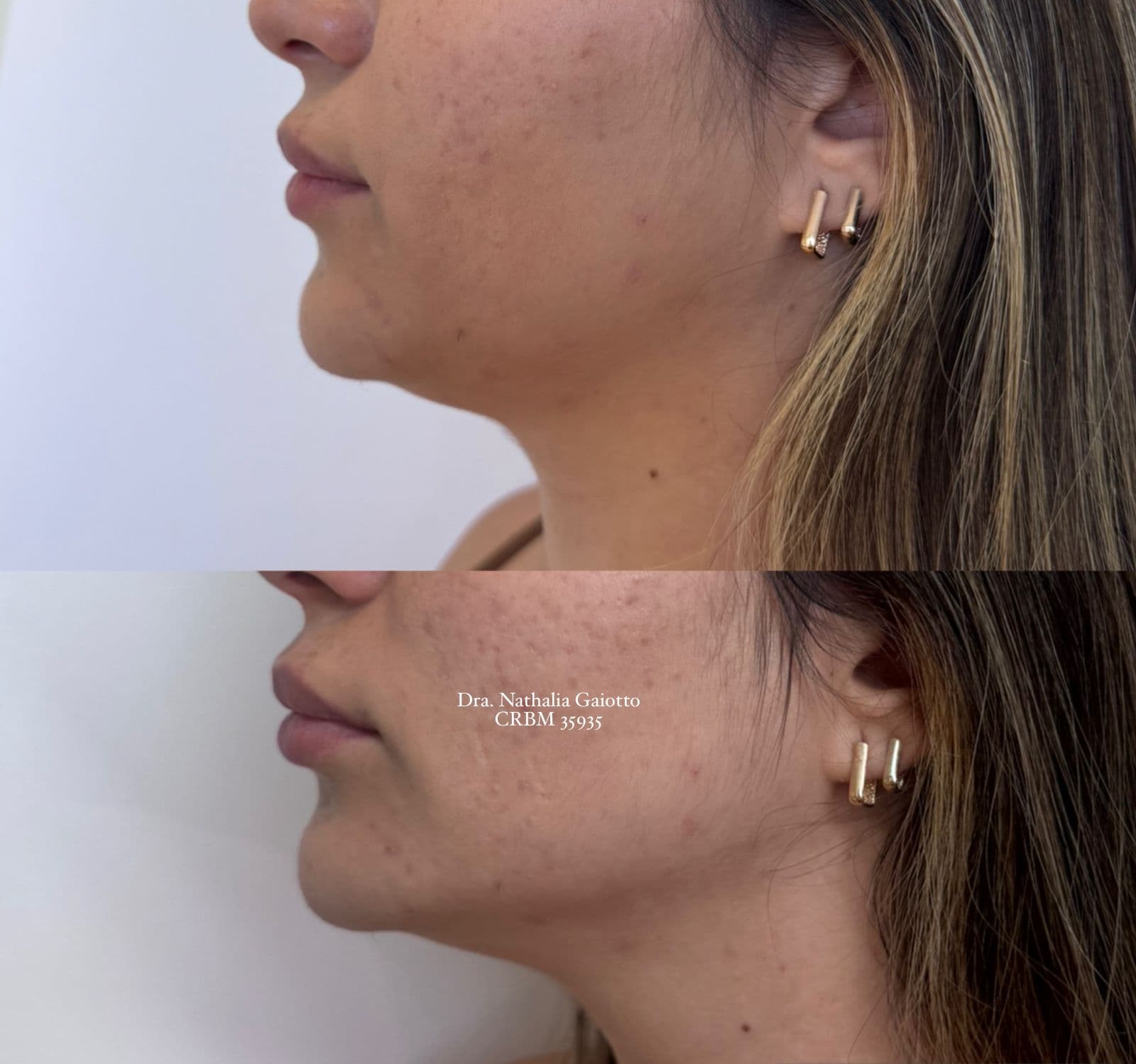 Antes e depois — Ultrassom Microfocado (HIFU), NG Clinic