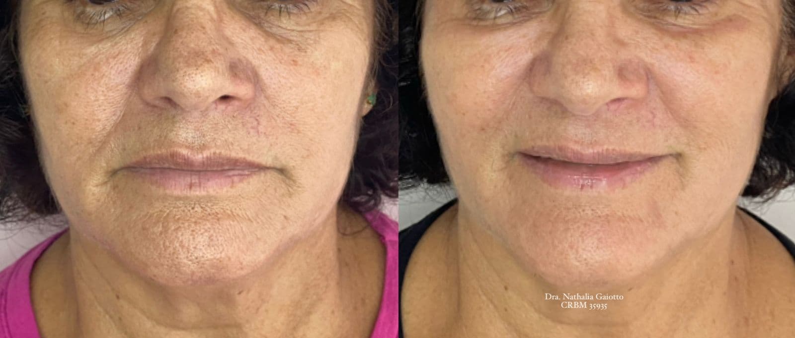 Antes e depois — Laser Facial, NG Clinic