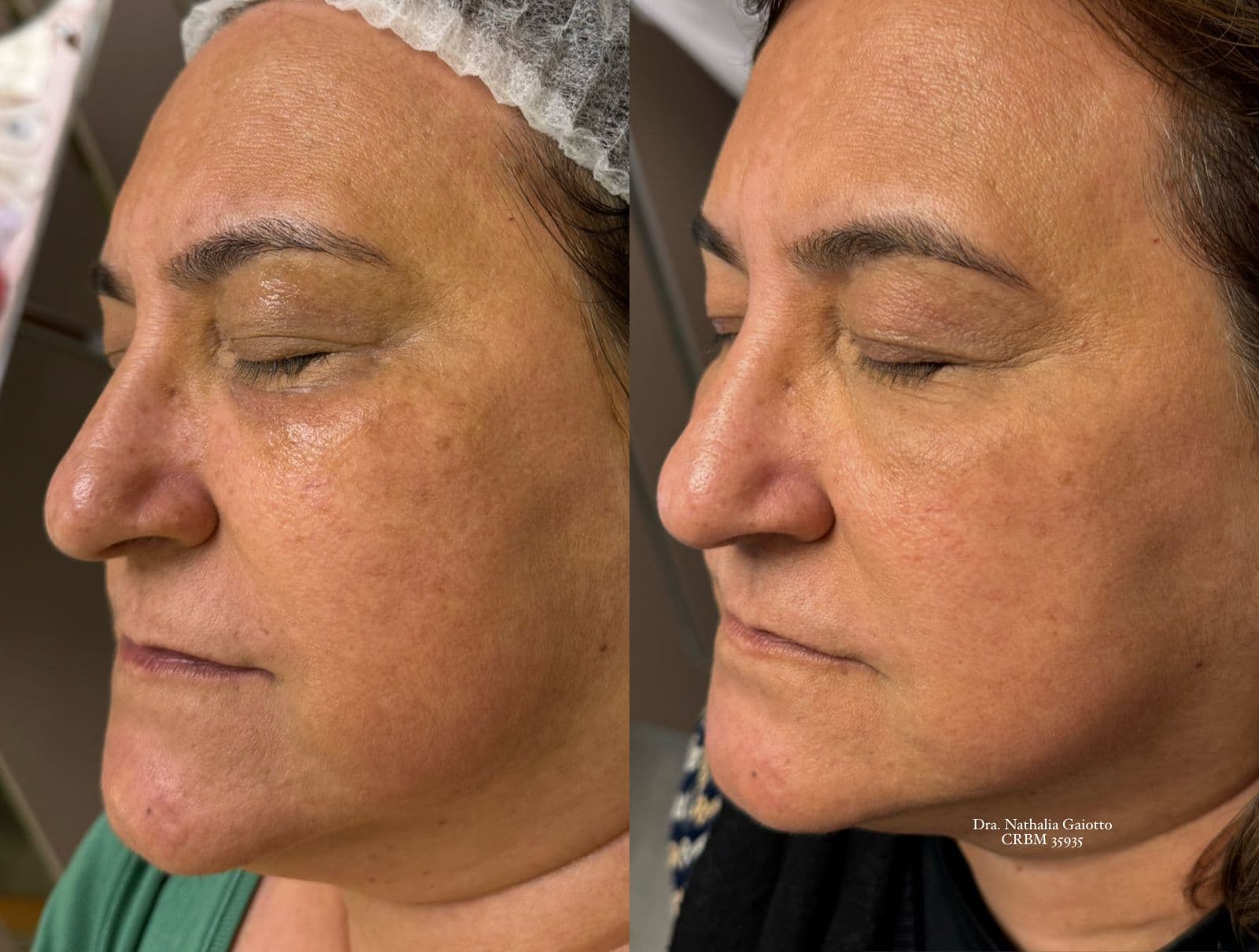 Antes e depois — Laser Facial, NG Clinic