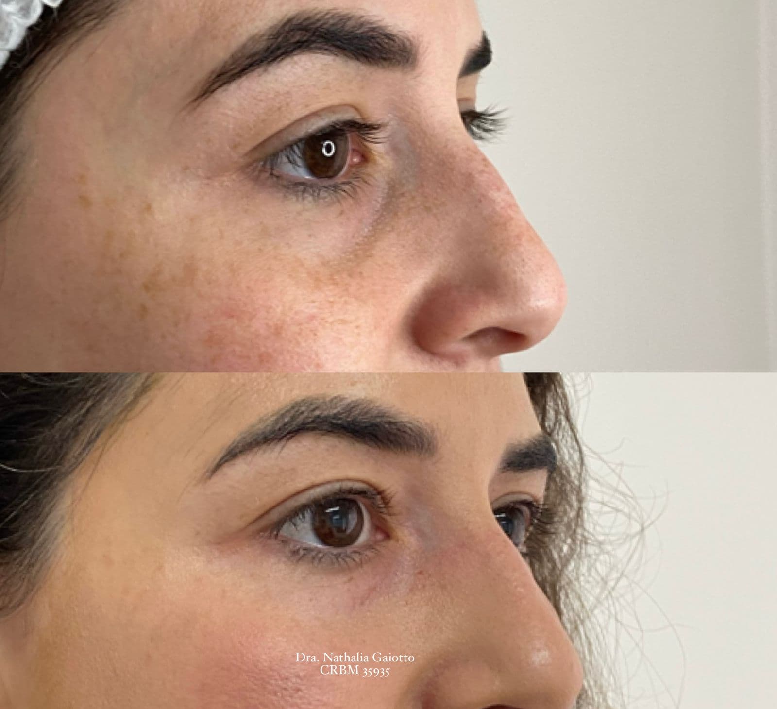 Antes e depois — Preenchimento Facial com Ácido Hialurônico, NG Clinic