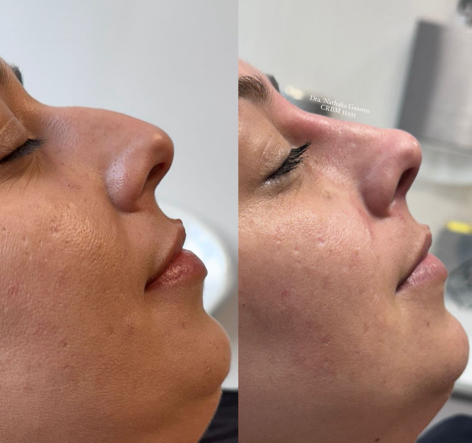 Antes e depois — Preenchimento Facial com Ácido Hialurônico, NG Clinic