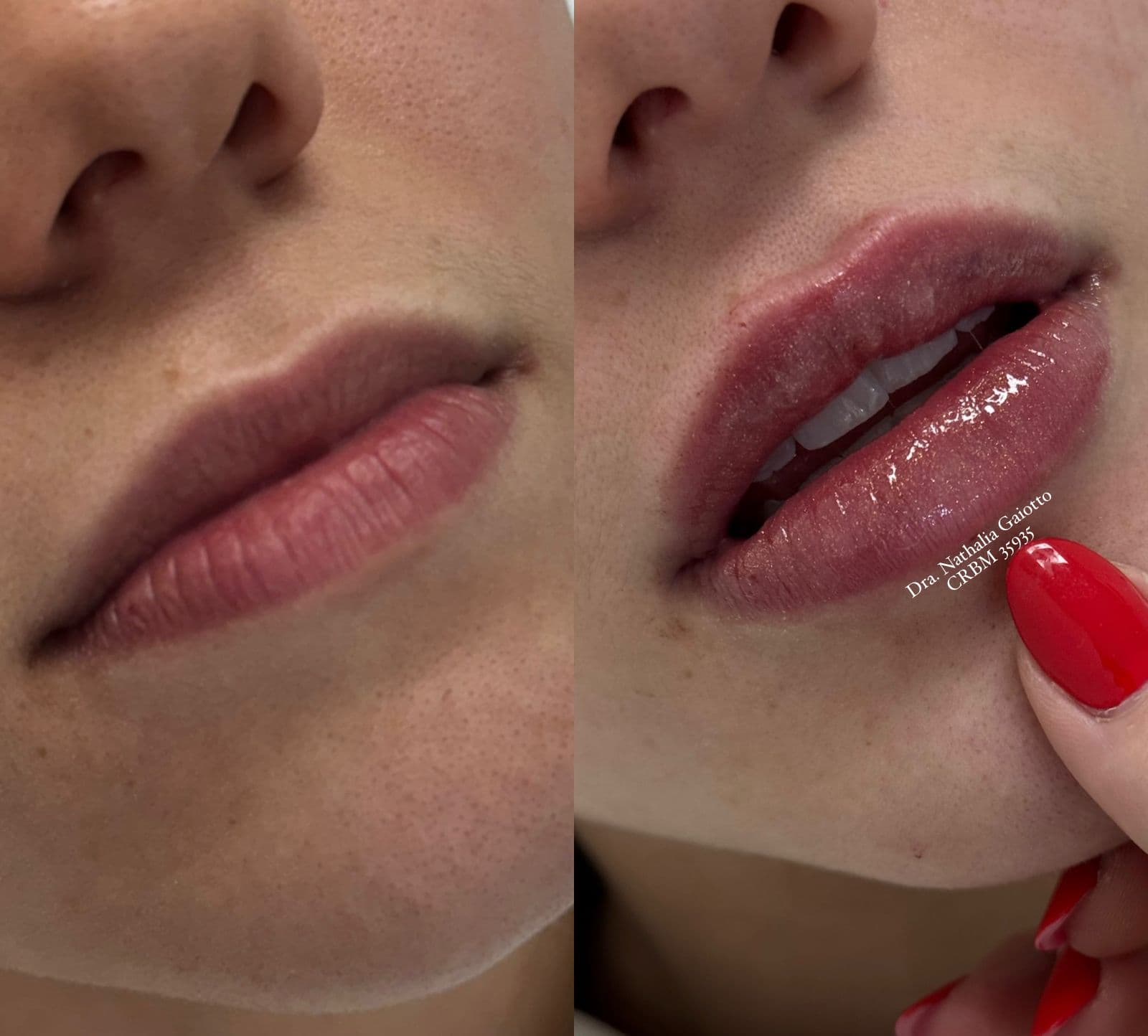 Antes e depois — Preenchimento Facial com Ácido Hialurônico, NG Clinic