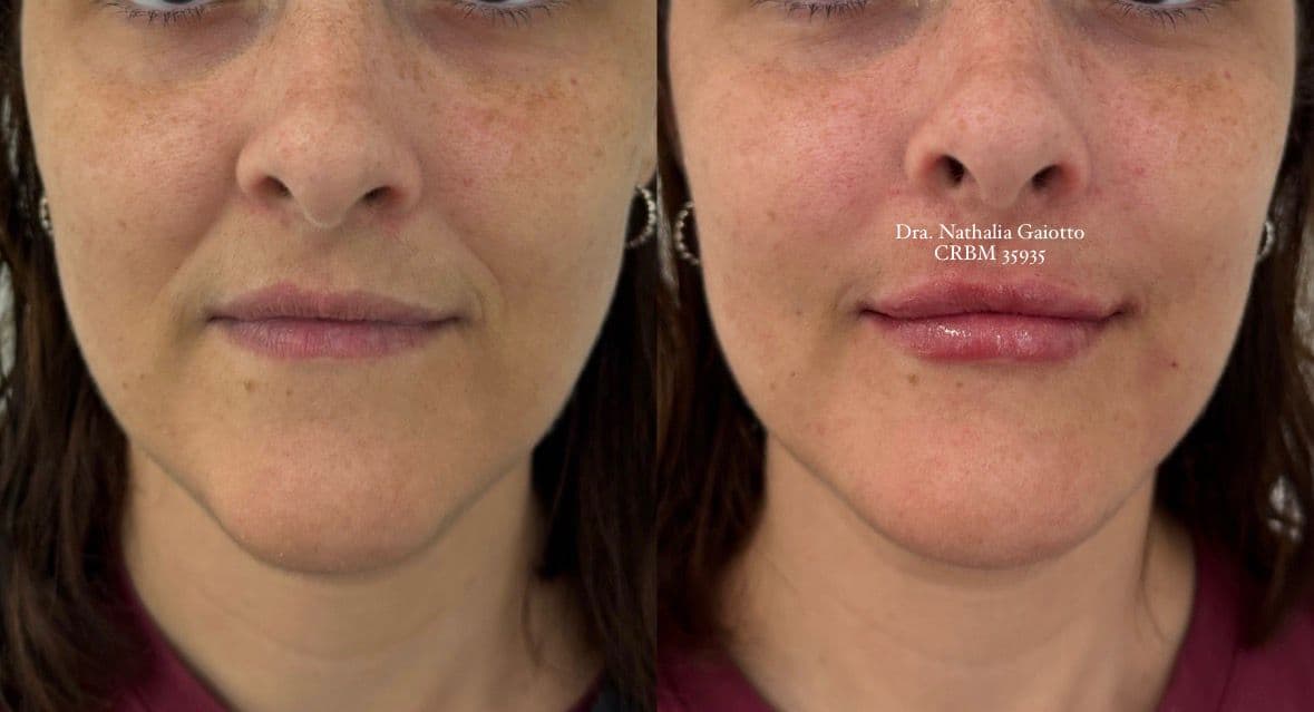 Antes e depois — Preenchimento Facial com Ácido Hialurônico, NG Clinic
