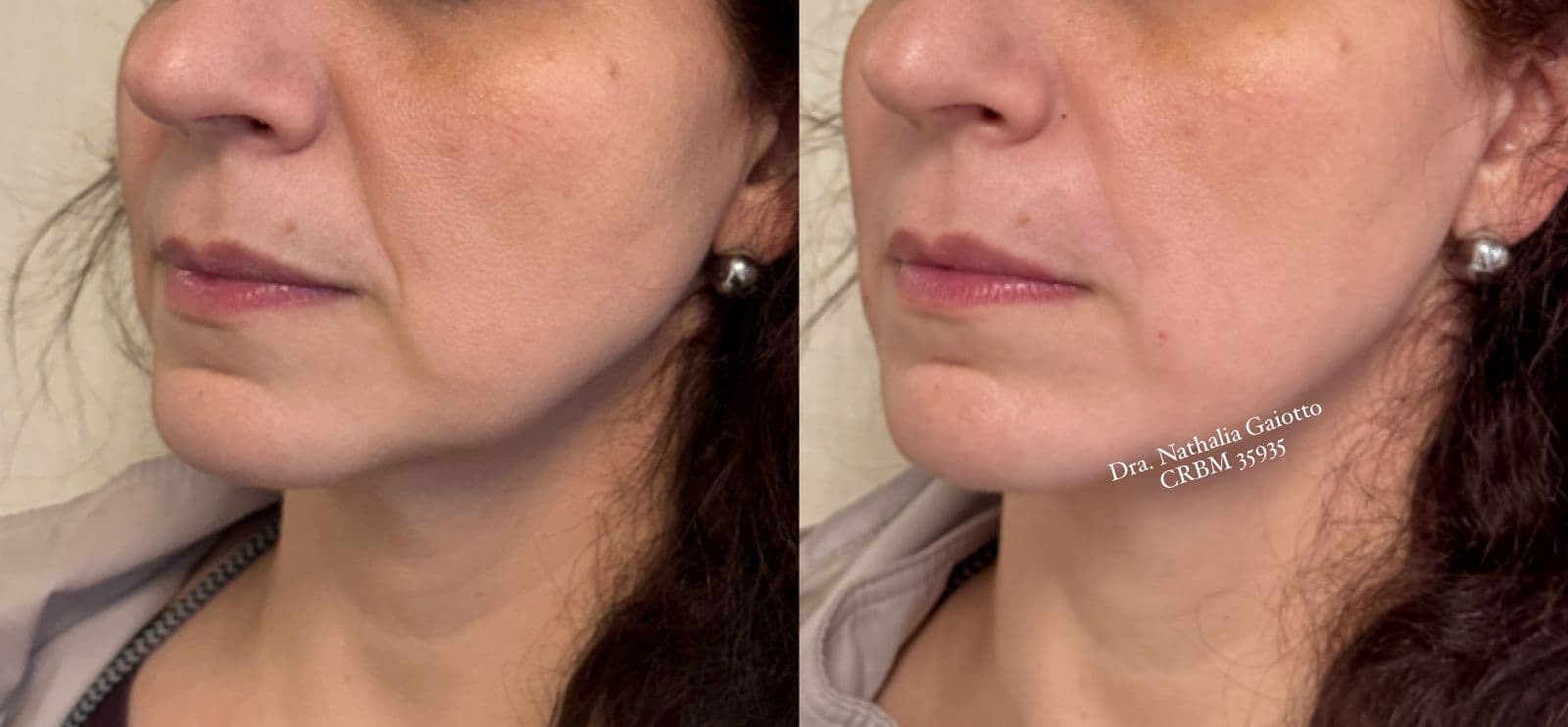 Antes e depois — Preenchimento Facial com Ácido Hialurônico, NG Clinic