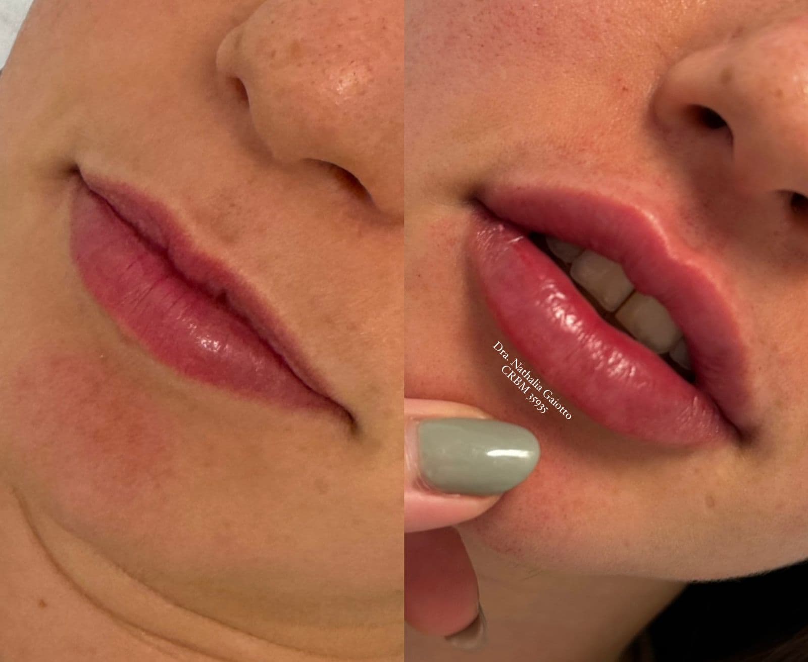 Antes e depois — Preenchimento Facial com Ácido Hialurônico, NG Clinic