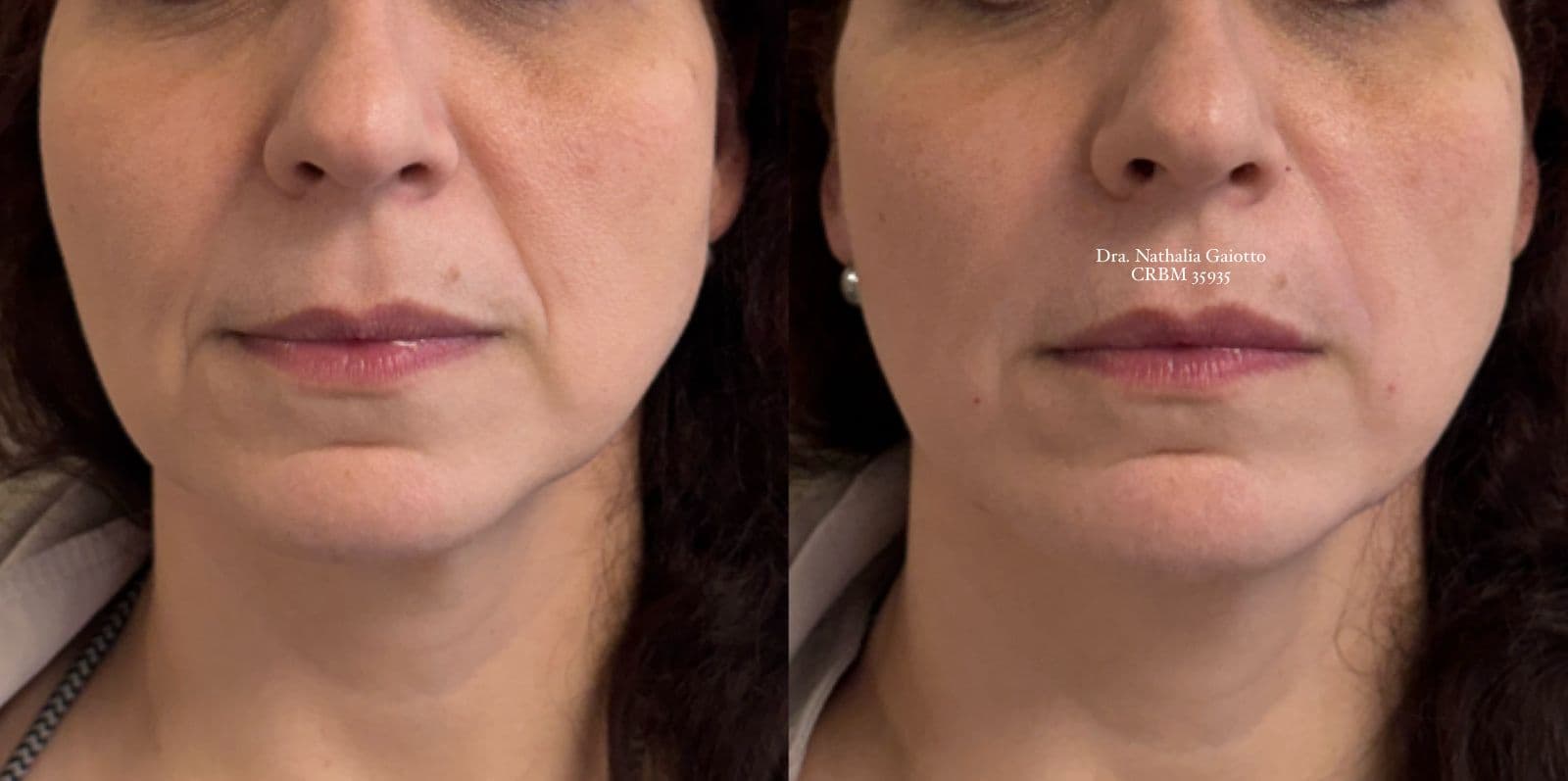 Antes e depois — Preenchimento Facial com Ácido Hialurônico, NG Clinic