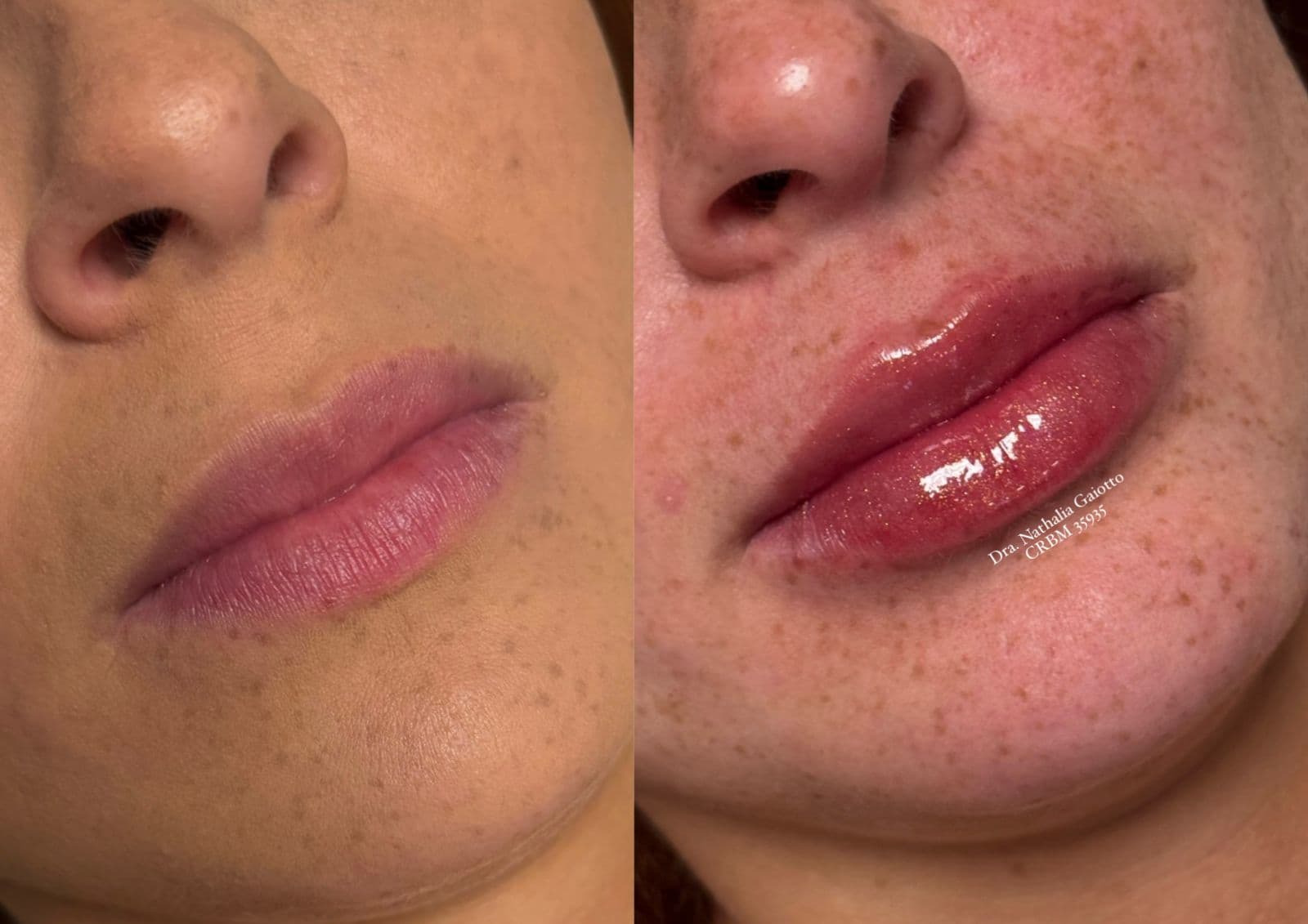 Antes e depois — Preenchimento Facial com Ácido Hialurônico, NG Clinic