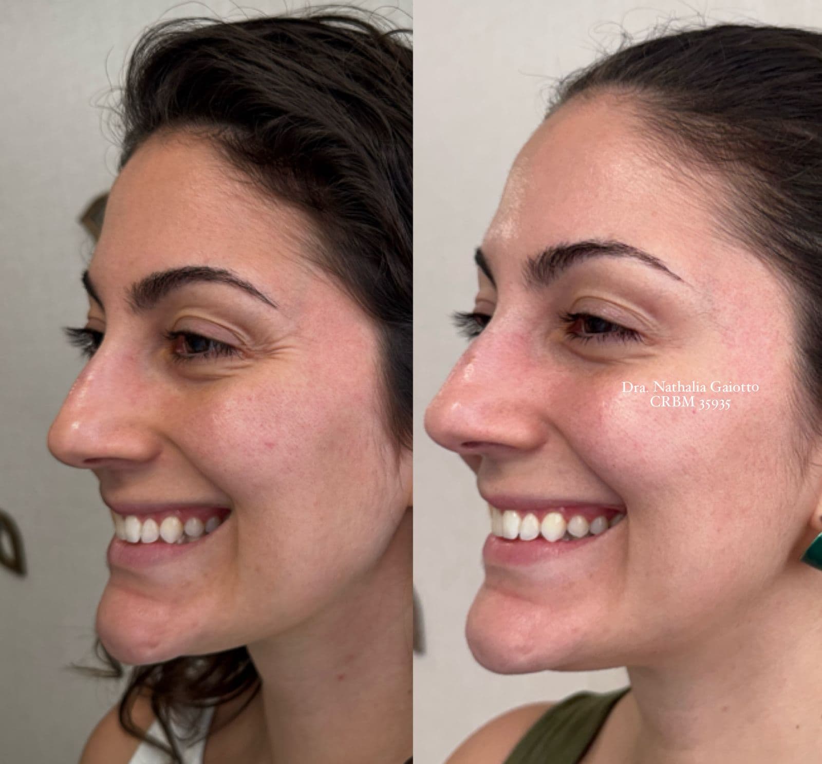 Antes e depois — Toxina Botulínica, caso 2