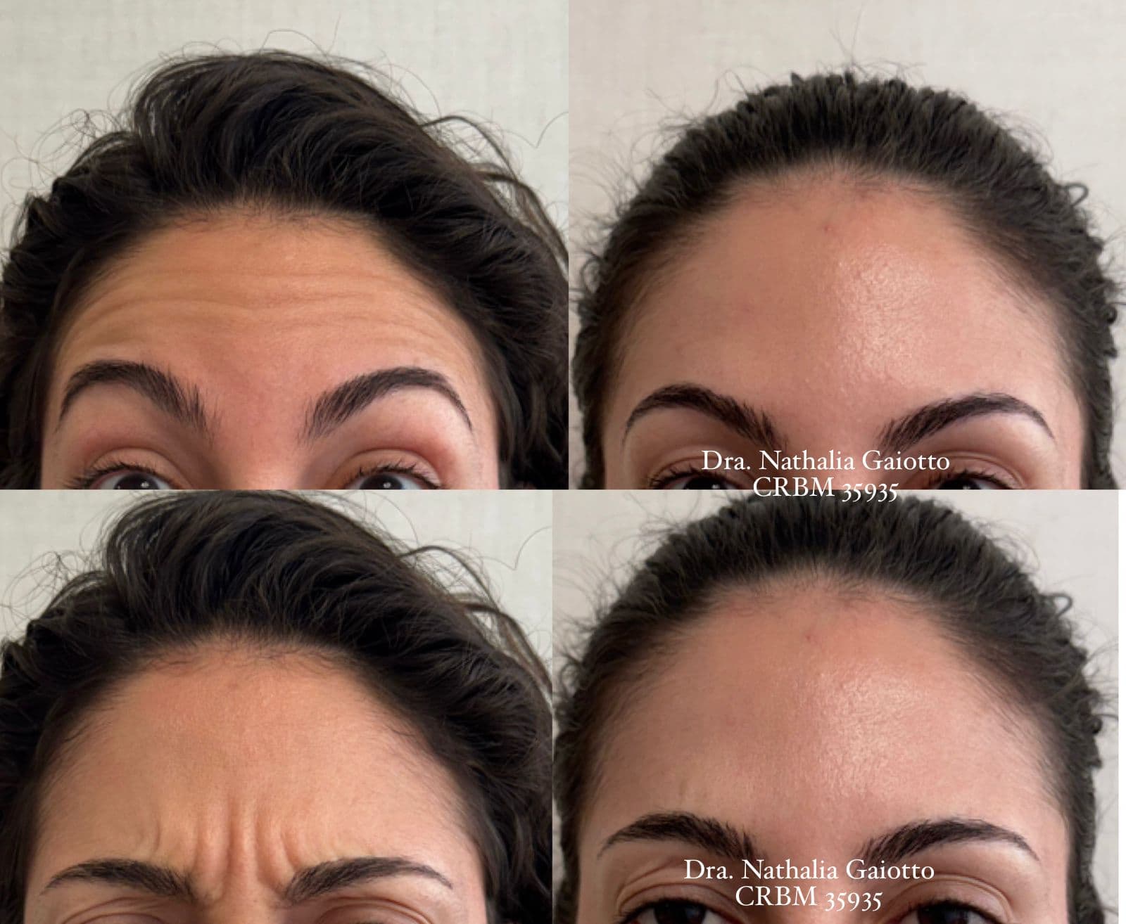 Antes e depois — Toxina Botulínica, caso 3