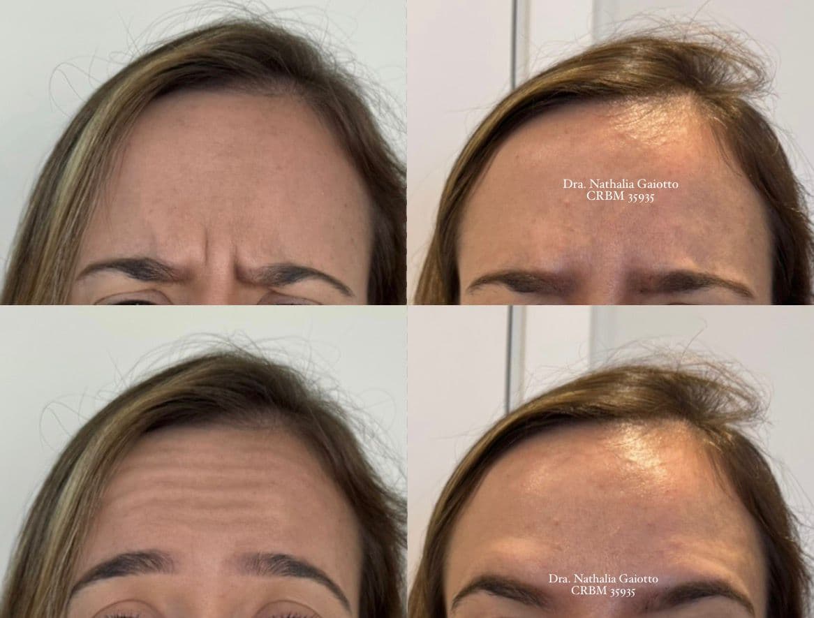 Antes e depois — Toxina Botulínica, caso 4