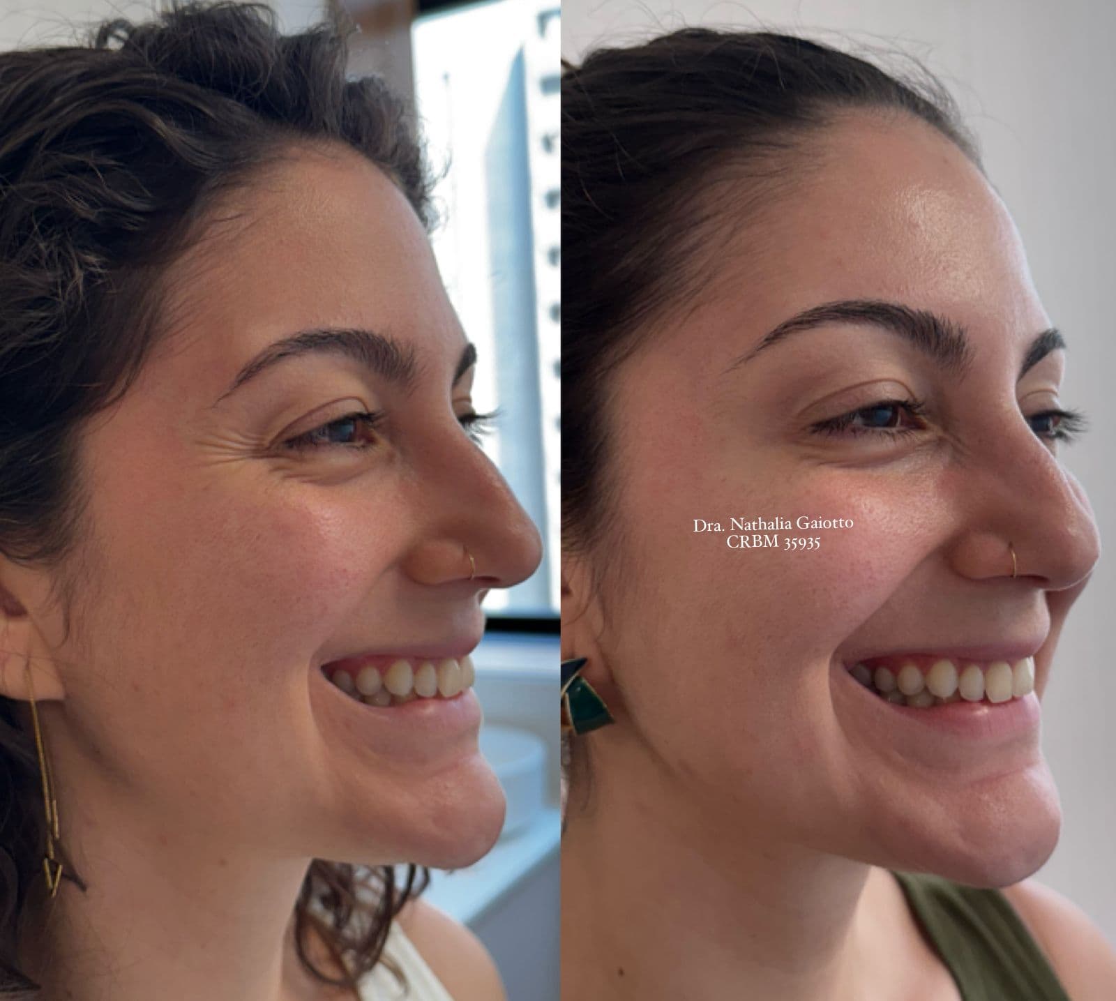 Antes e depois — Toxina Botulínica, caso 5