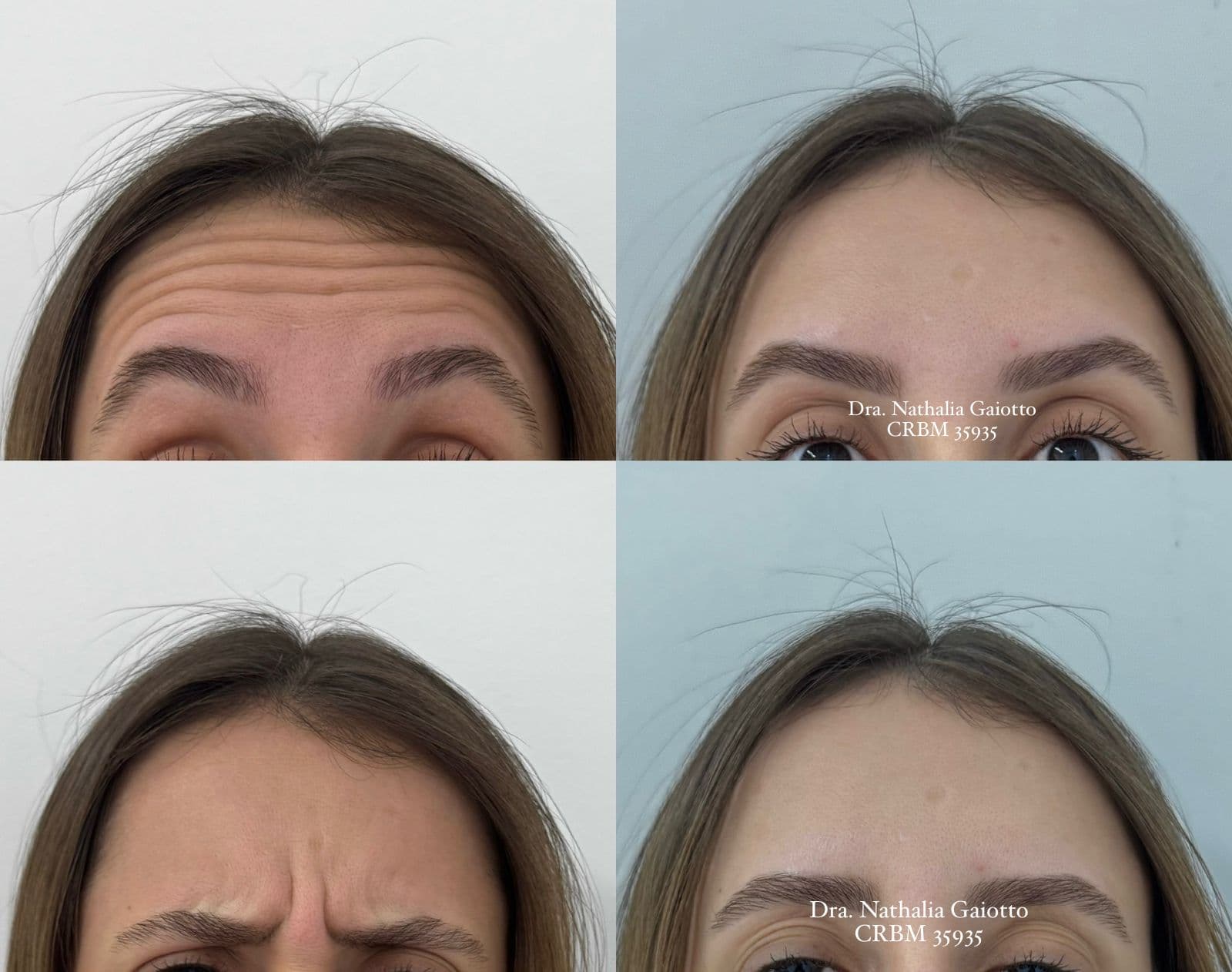 Antes e depois — Toxina Botulínica, caso 6