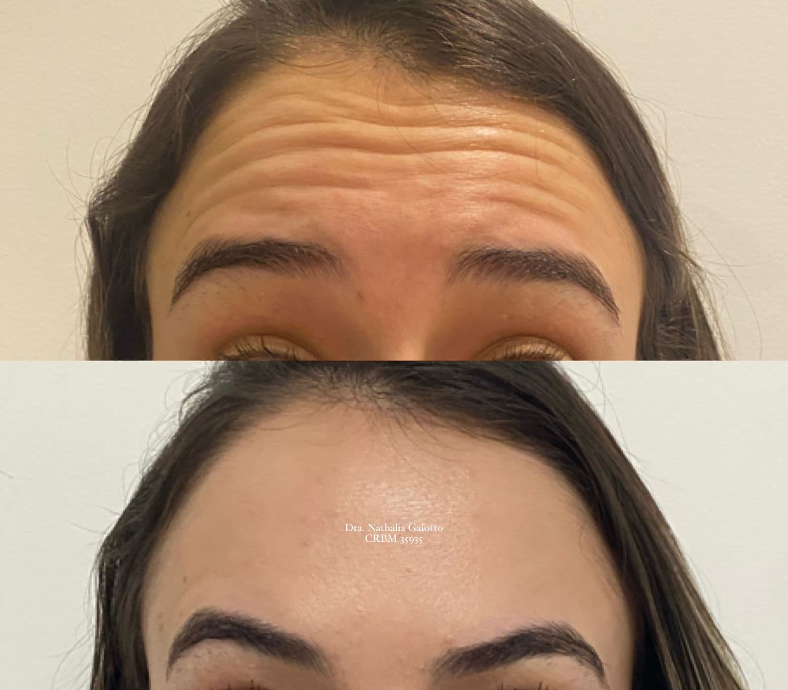 Antes e depois — Toxina Botulínica, NG Clinic